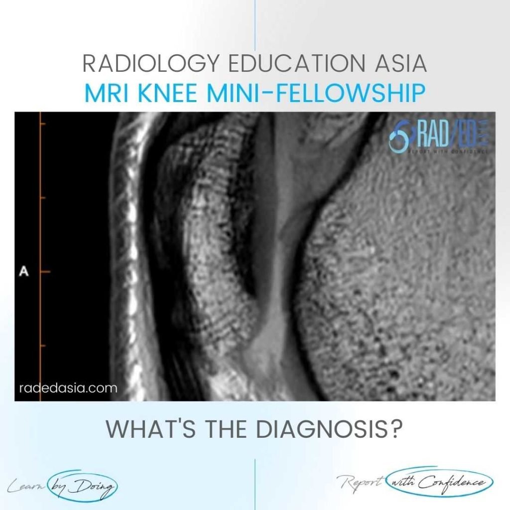chondromalacia patella femoral trochlear knee cartilage mri radiology radedasia