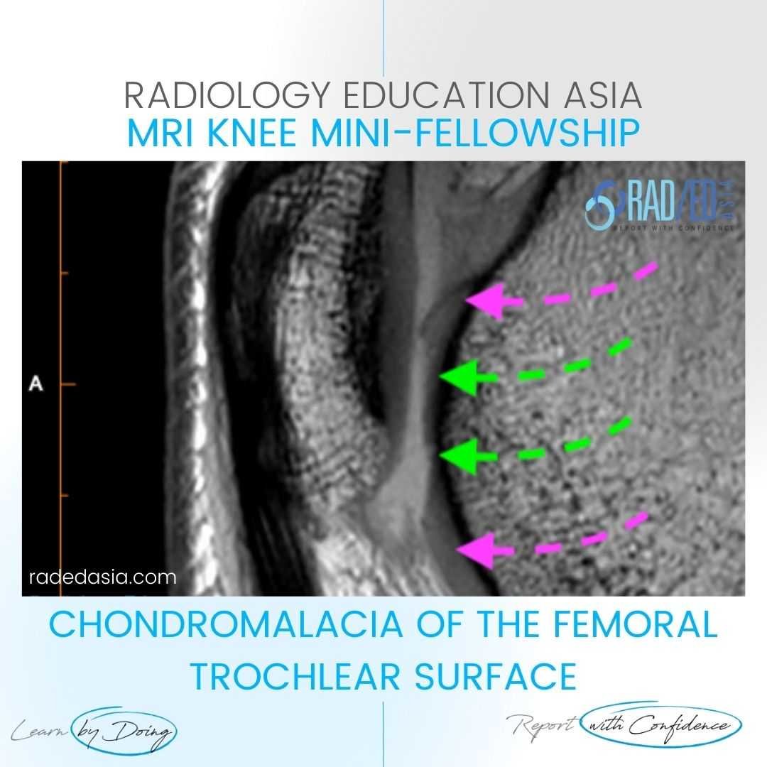 chondromalacia patella femoral trochlear knee cartilage mri radiology