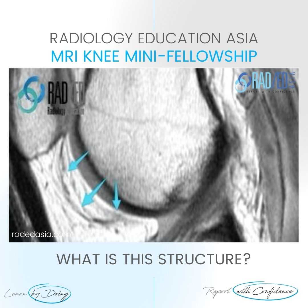 KNEE INFRAPATELLAR PLICA SYNDROME RADIOLOGY MRI - Radedasia