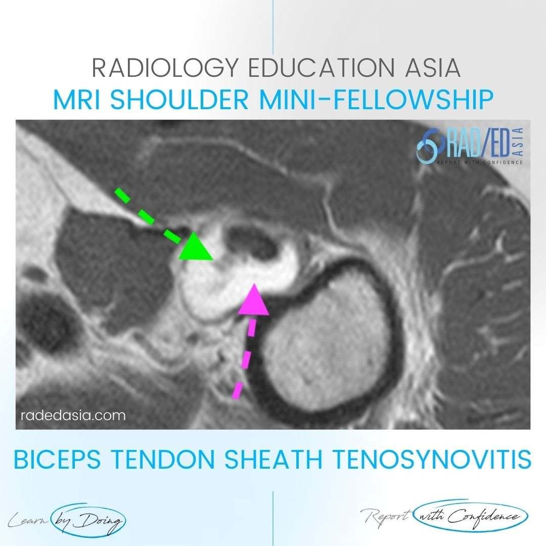 mri biceps tenosynovitis tendon sheath effusion tendinitis tendonitis