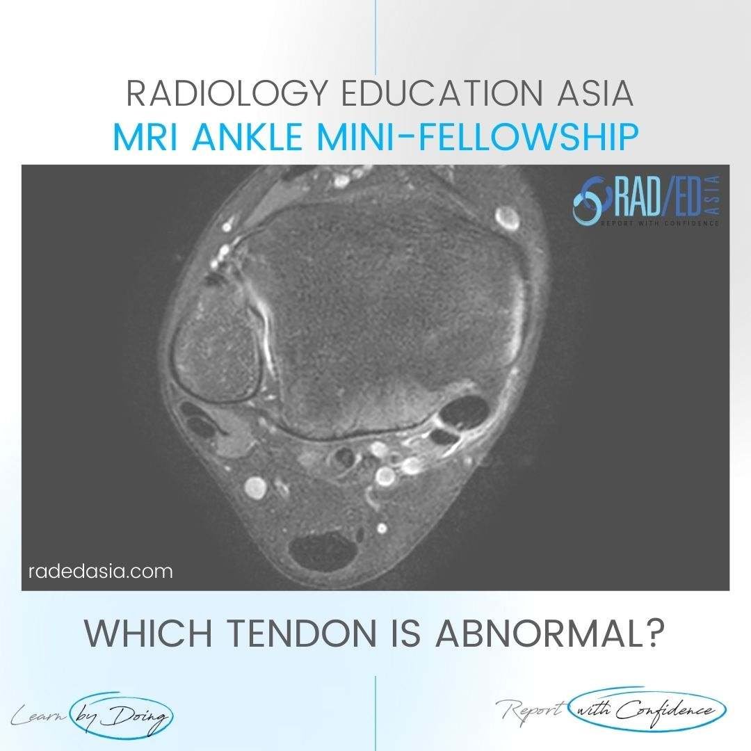 tibialis posterior tendinopathy mri radiology radedasia
