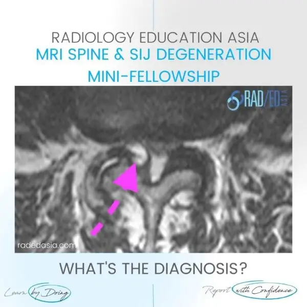 facet synovial cyst radiology lumbar spine mri