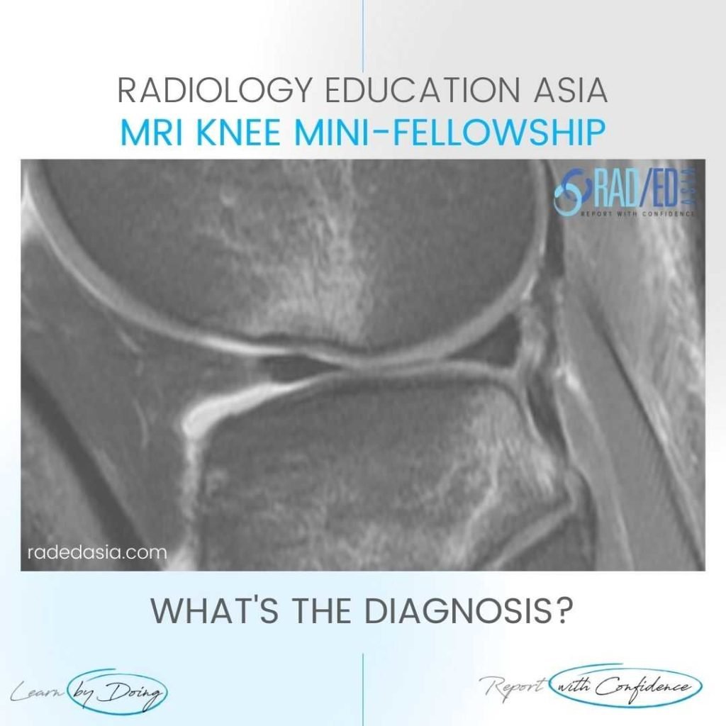 mri acl tear pivot shift injury bone contusion pattern osteochondral fracture knee