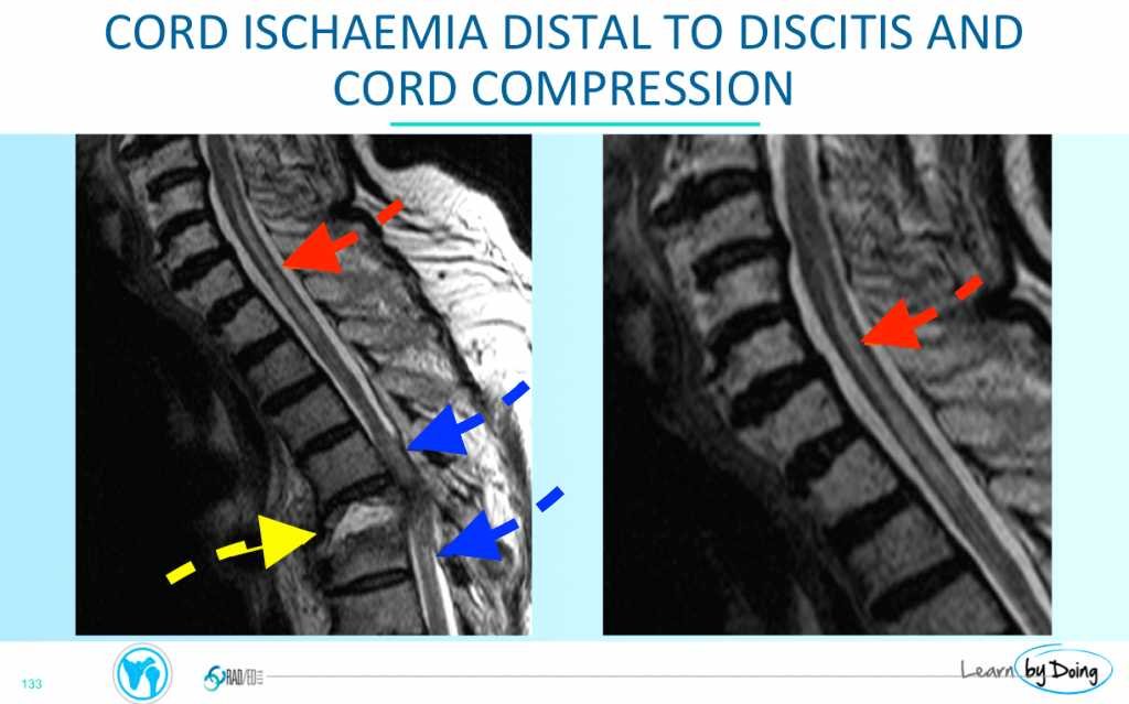 mri spine cord ischaemia tb tuberculosis radiology education