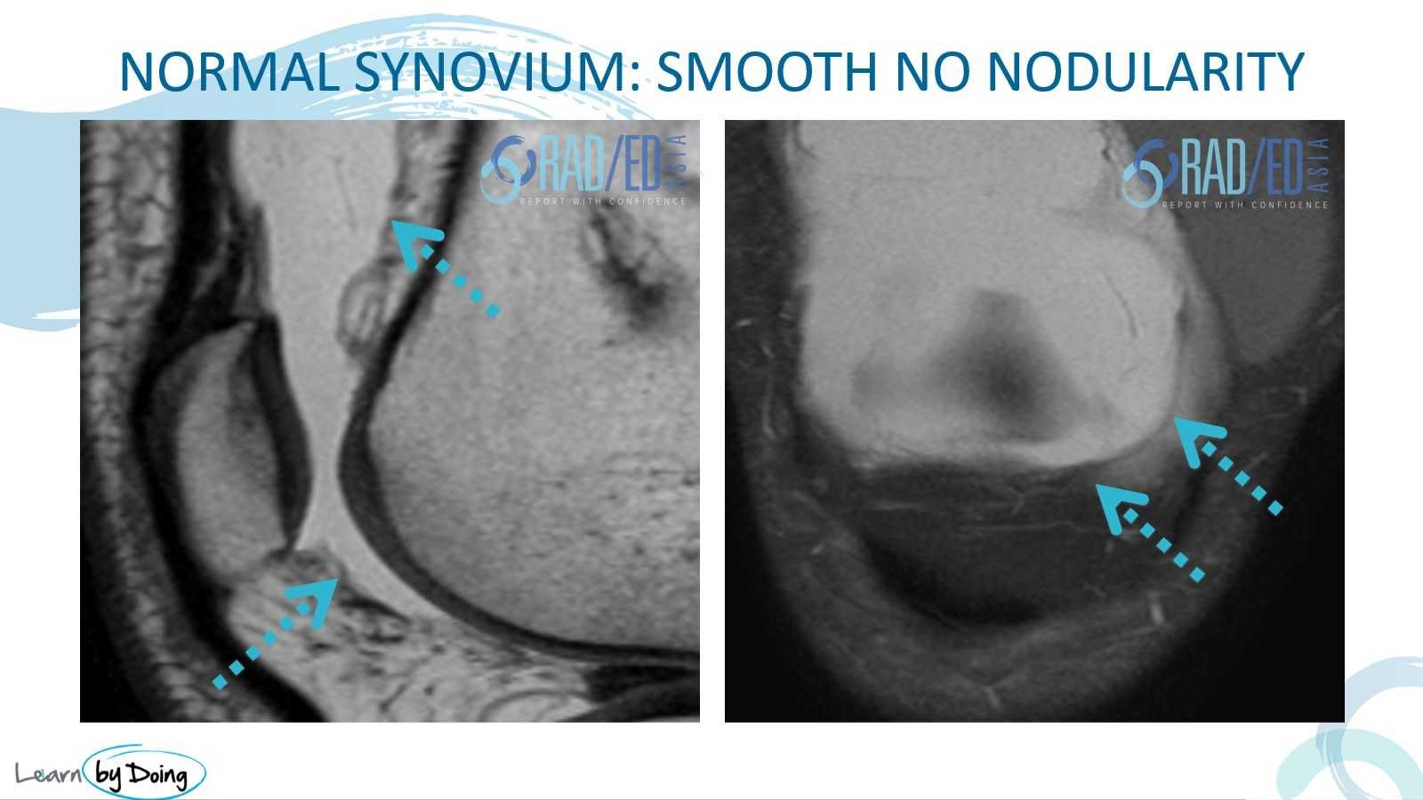 mri synovitis knee normal synovium radedasia