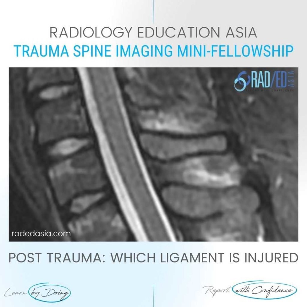 spine ligaments mri injury radiology interspinous trauma