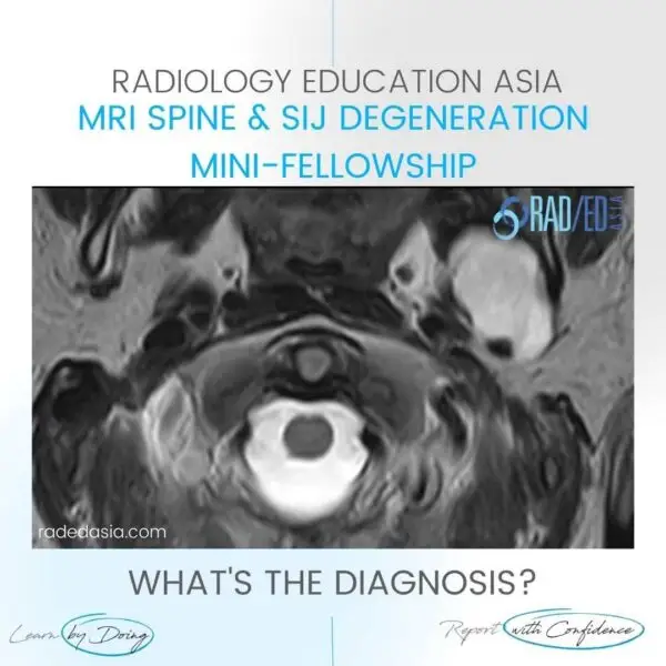 spine mri incidental findings parotid mass