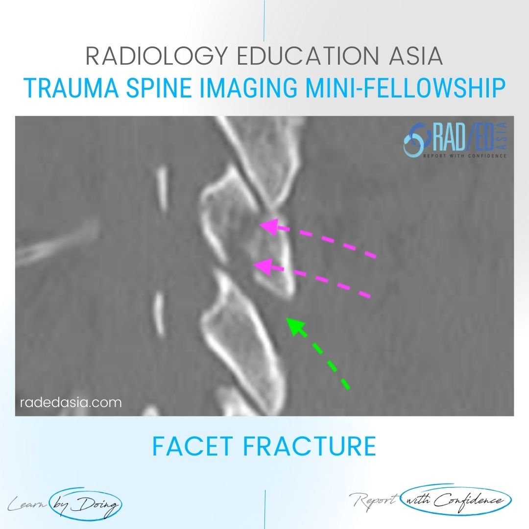 spine trauma imaging facet fracture dislocation ct radiology