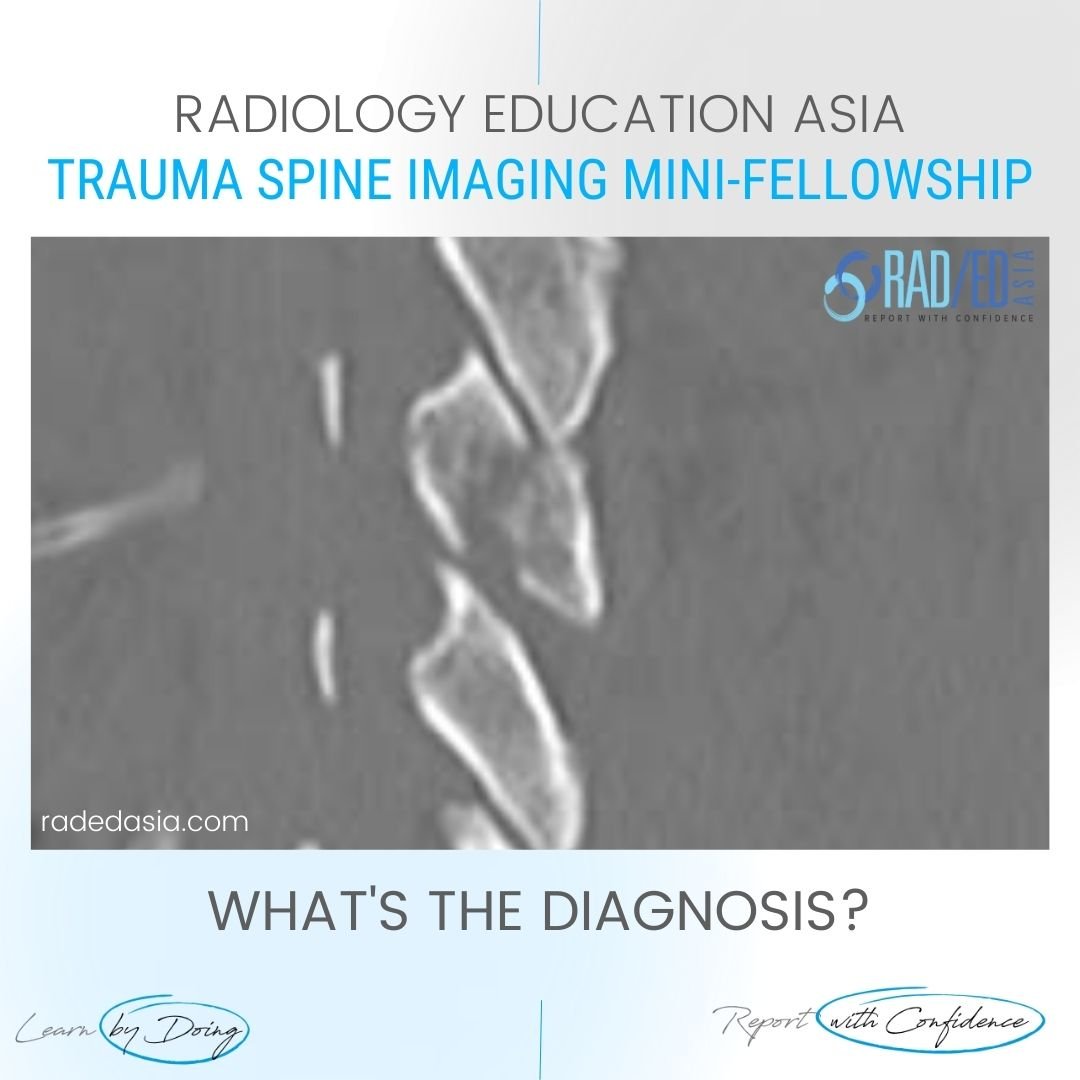 spine trauma imaging facet fracture dislocation radiology ct