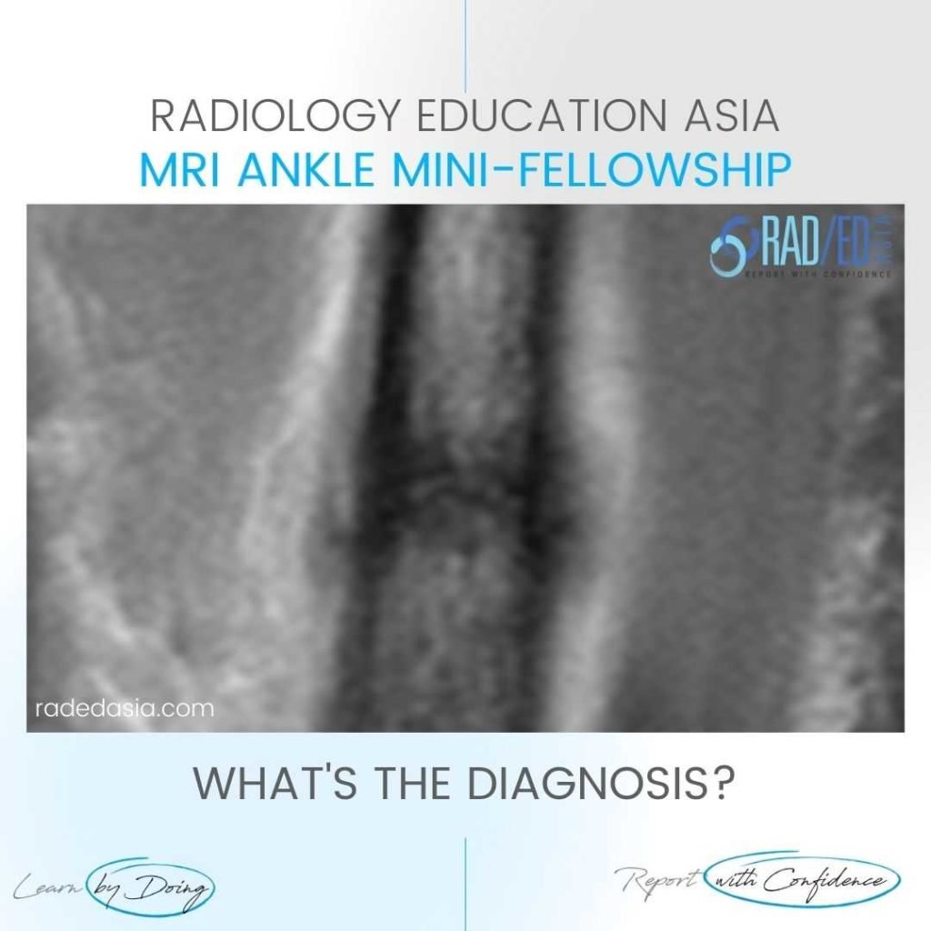 stress fracture fibula shin mri radiology xray periosteal radedasia