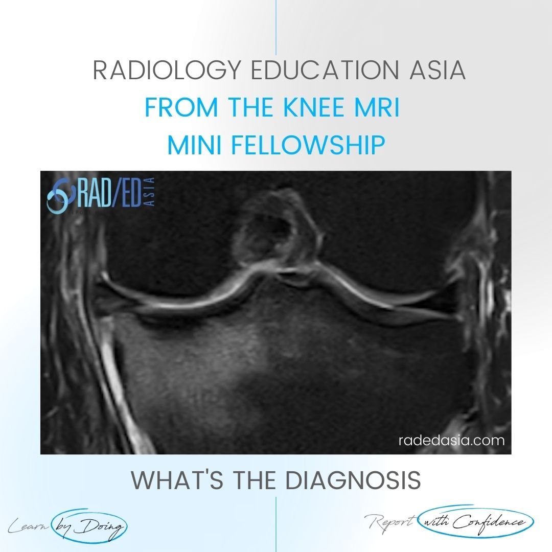 subcortical subchondral fracture knee tibial plateau mri insufficiency