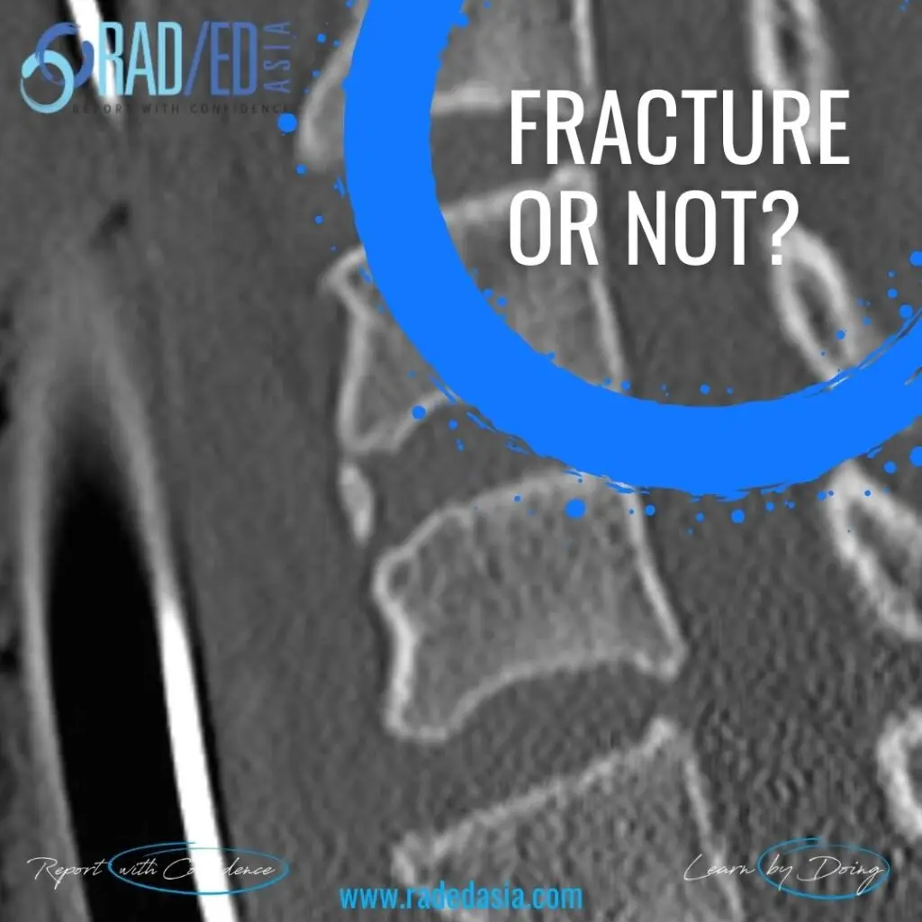 cervical teardrop fracture radiology xray radedasia