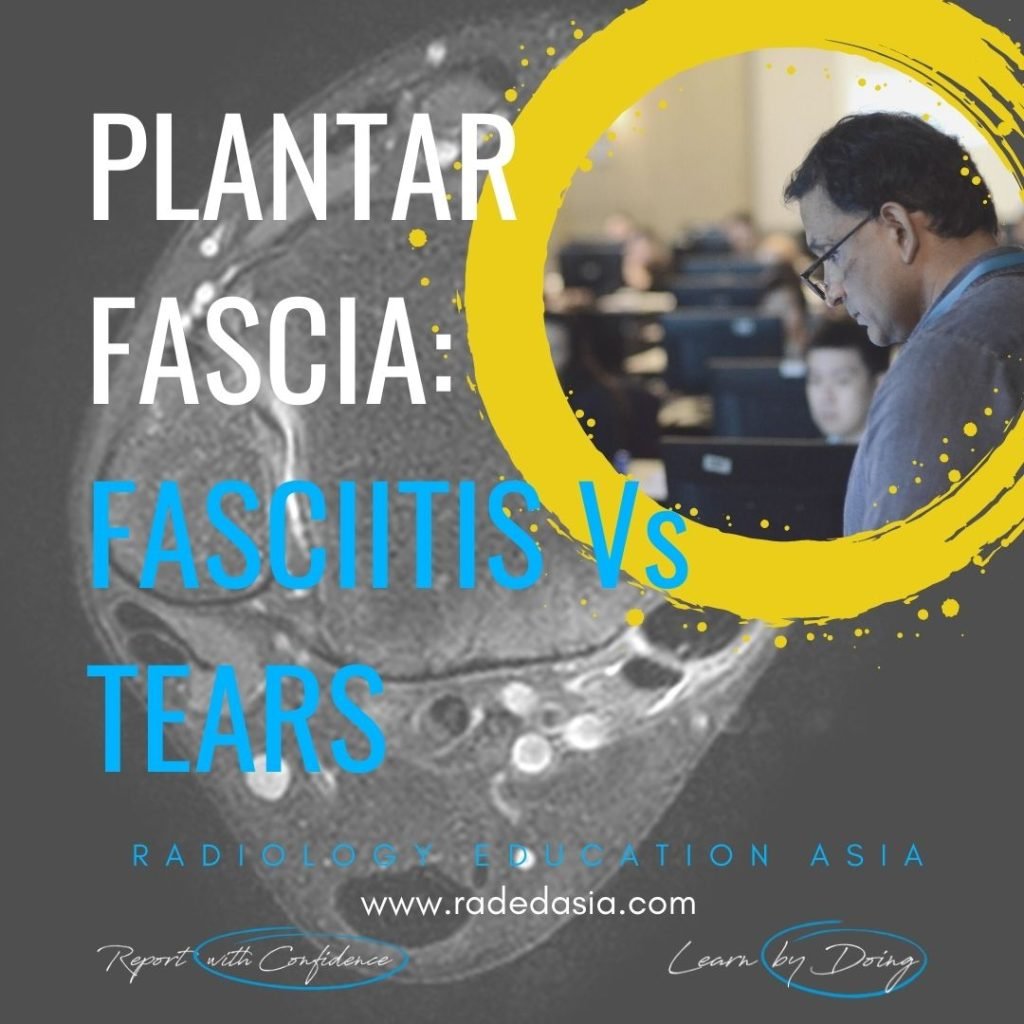 mri plantar fascia plantar fasciitis plantar fascia tear learn radiology radedasia