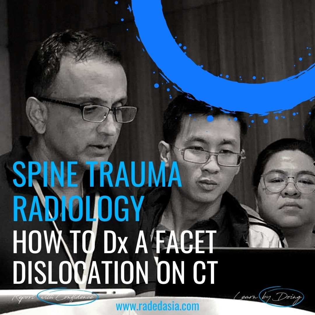 spine trauma radiology facet dislocation subluxation perched locked ct imaging radedasia