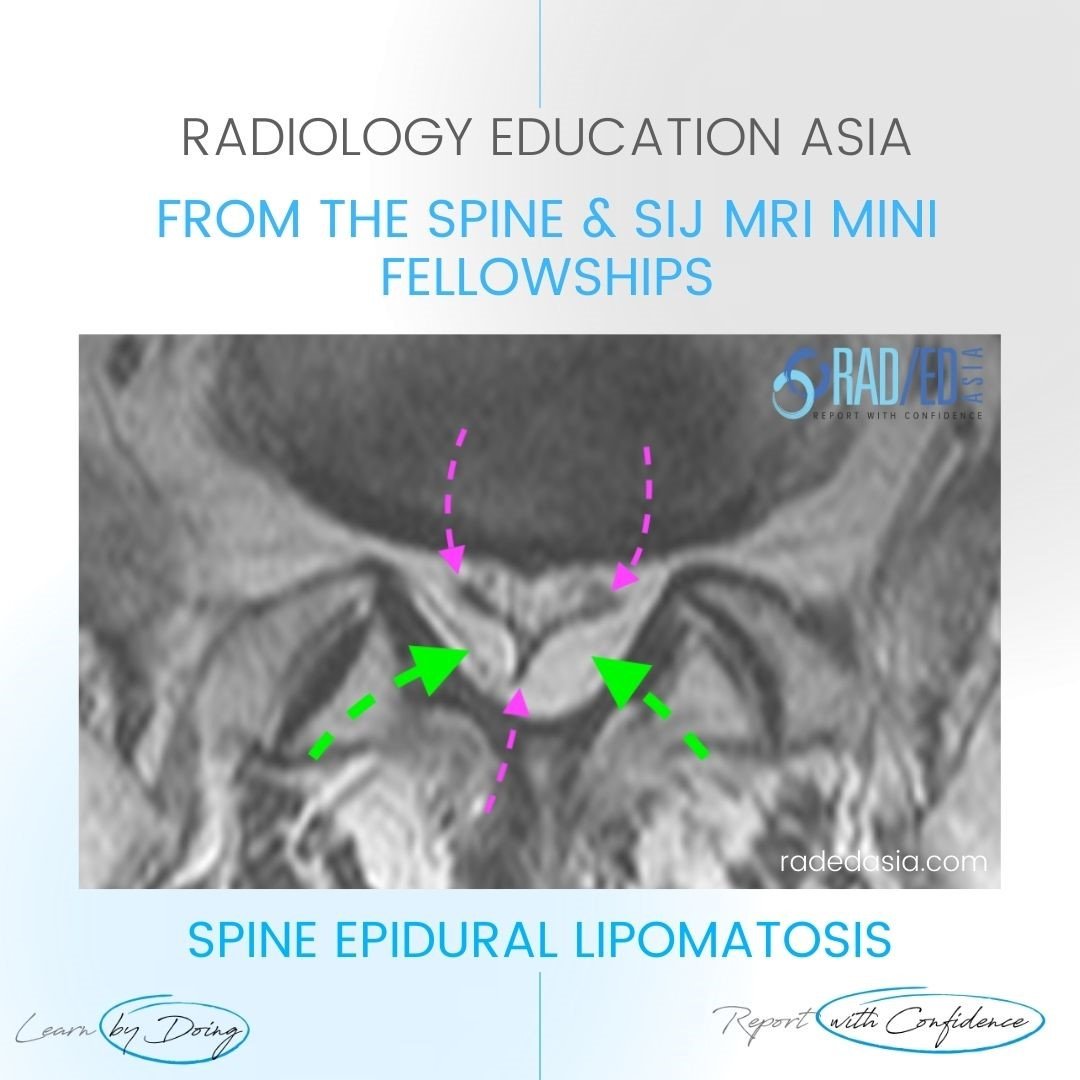 epidural lipomatosis radiology mri radedasia
