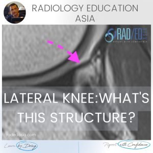 popliteomeniscal fasicle mri radiology tear anatomy lateral knee radedasia