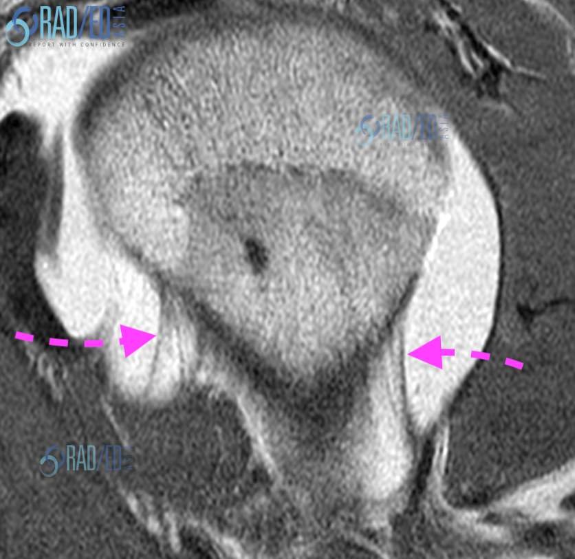 oskspr Q21 isynovial folds radedasia
