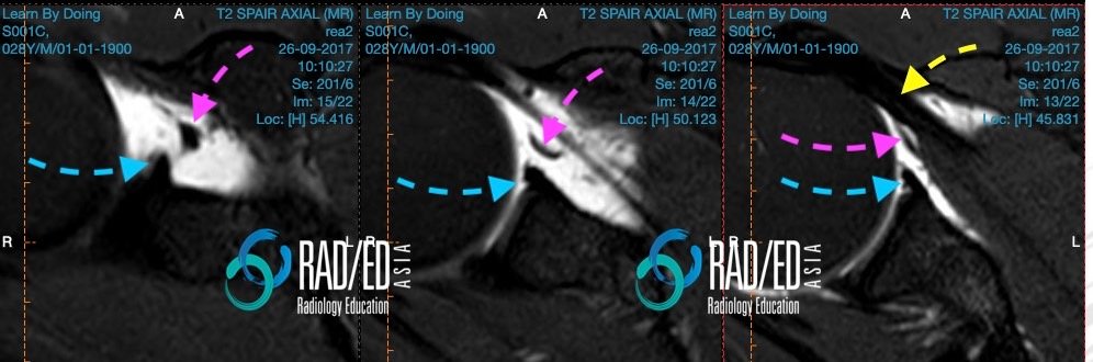 oskspr Q27 28 mghl normal S001C shoulder mri msk radiology radedasia