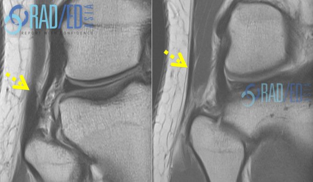 OSKSPR KQ39 lateral knee radiology biceps femoris mri imaging radedasia