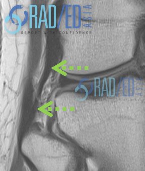 OSKSPR KQ40 lateral knee radiology biceps lateral collateral lig mri imaging radedasia