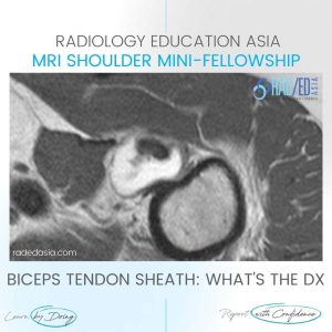 biceps tenosynovitis mri tendon sheath effusion tendinitis tendonitis radedasia