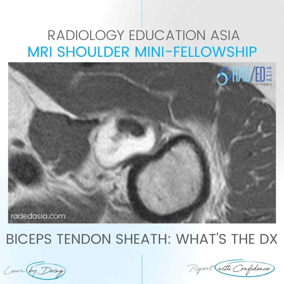 biceps tenosynovitis mri tendon sheath effusion tendinitis tendonitis radedasia