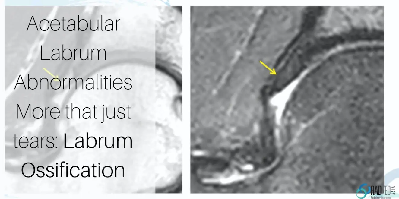 hip labrum ossification mri