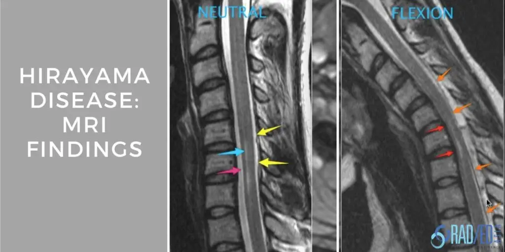 hirayamas-disease-mri-radiology-education-asia-radedasia