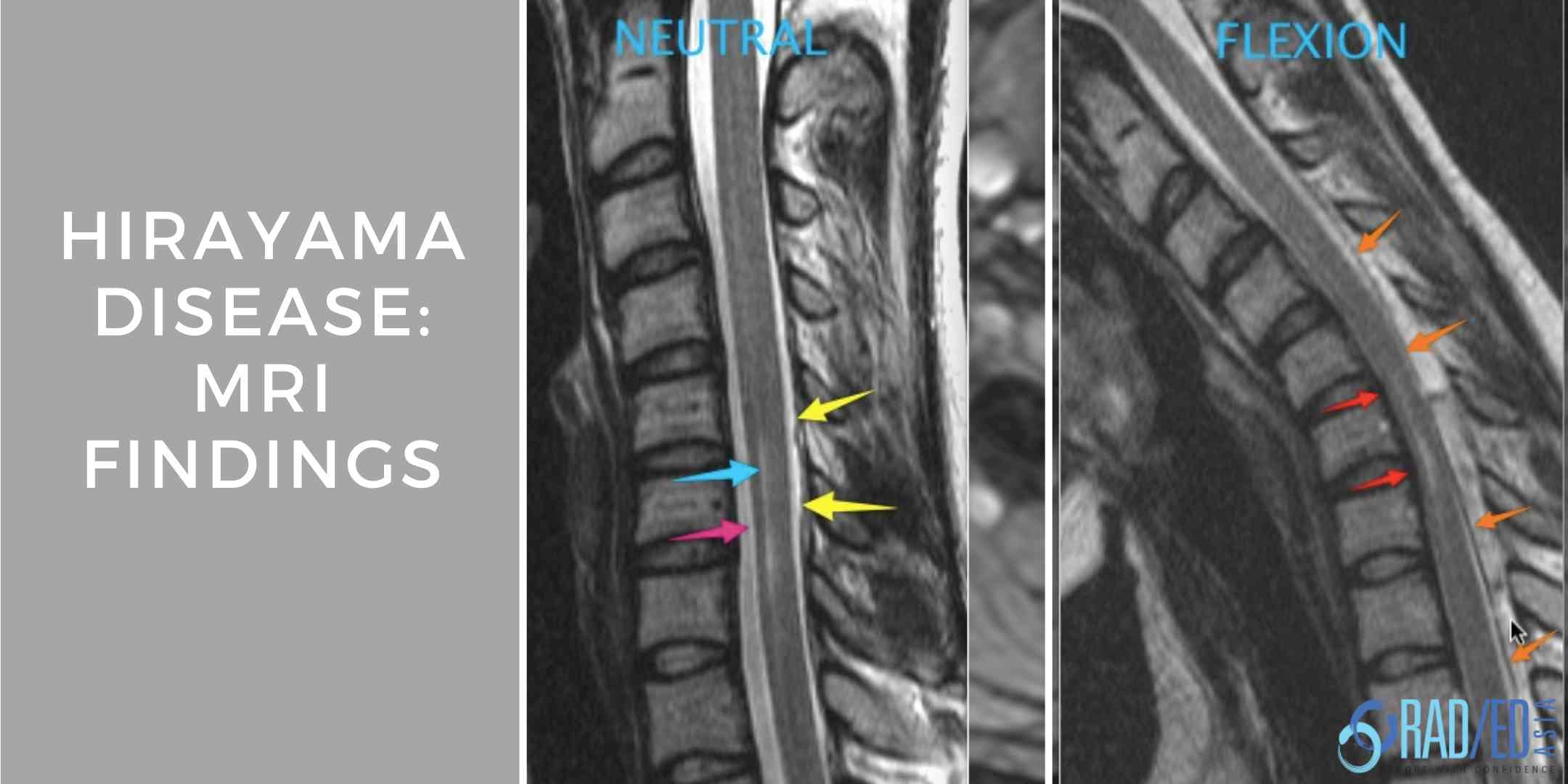 hirayamas-disease-mri-radiology-education-asia-radedasia