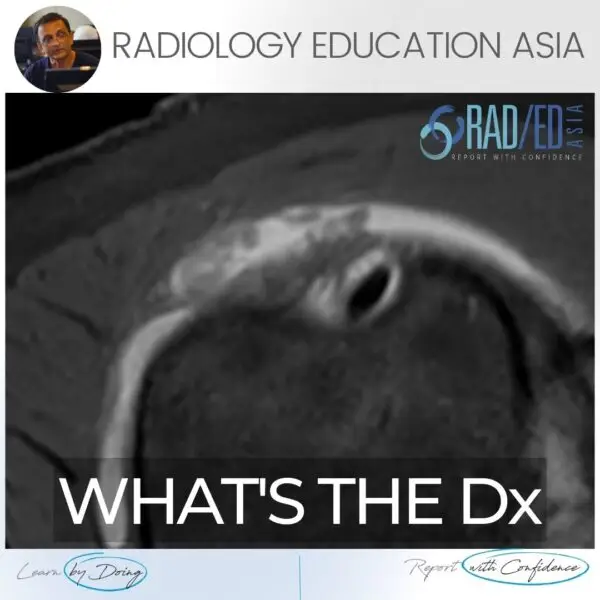 subacromial subdeltoid bursa bursitis msk mri radiology radedasia