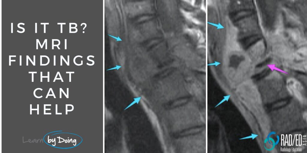 tb-spine-tuberculosis-mri-radiology-education-asia