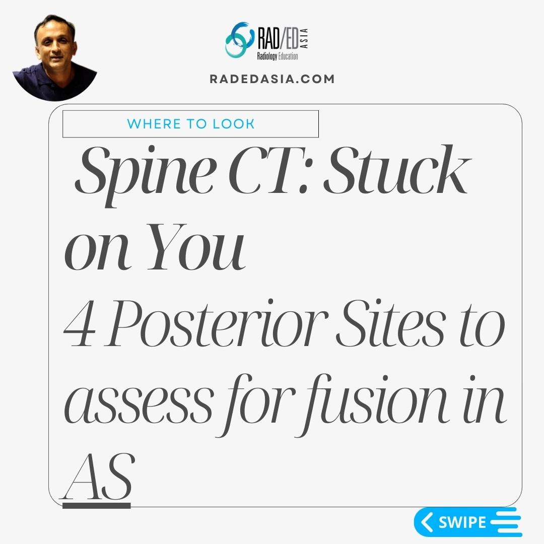 ankylosing spondylitis spine radiology ct mri fusion images