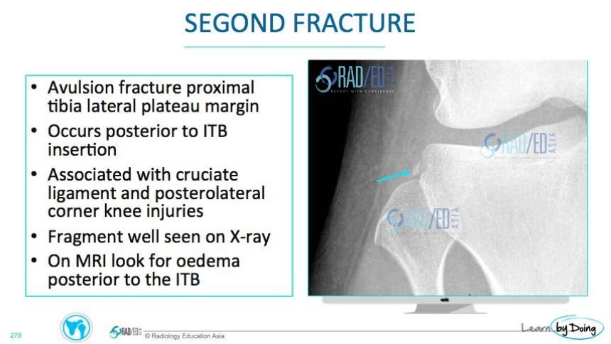 mri-knee-segond-fracture-radiology-education-asia