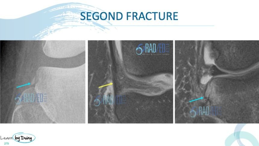 mri-knee-segond-fracture-xray-radiology-education-asia