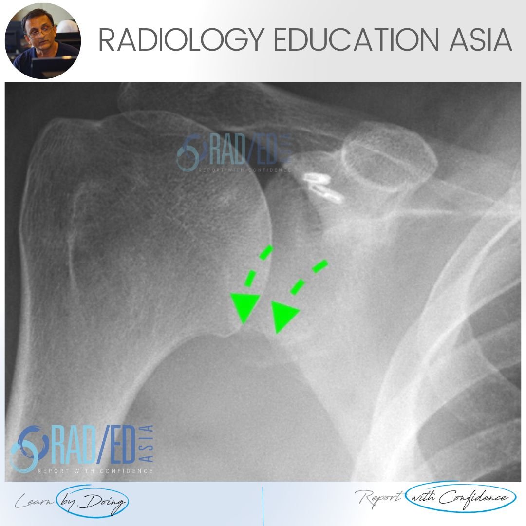 shoulder dislocation bony bankart glenoid fracture ct xray radiology