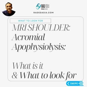 Acromial apophysiolysis and key imaging features to assess in symptomatic patients.