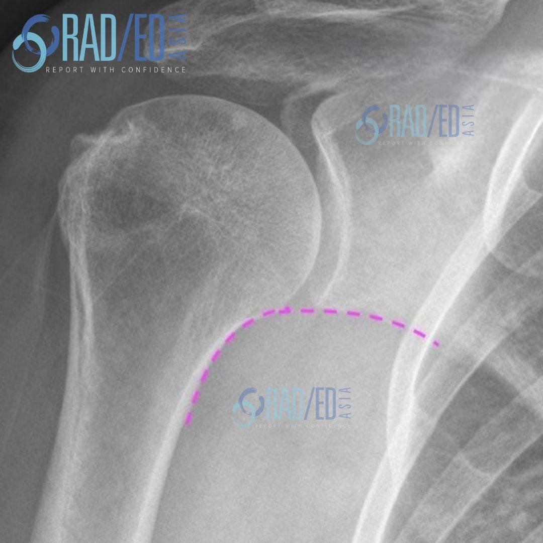 glenohumeral joint humeral subluxation humerus scapulohumeral moloney's line gothic arch mri radiology xray radedasia rea