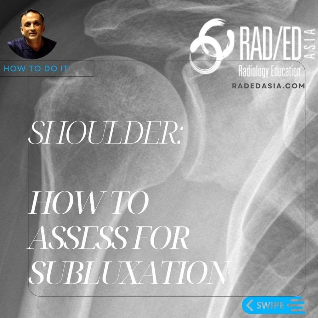 glenohumeral joint subluxation humeral humerus scapulohumeral moloney's line gothic arch radiology xray mri