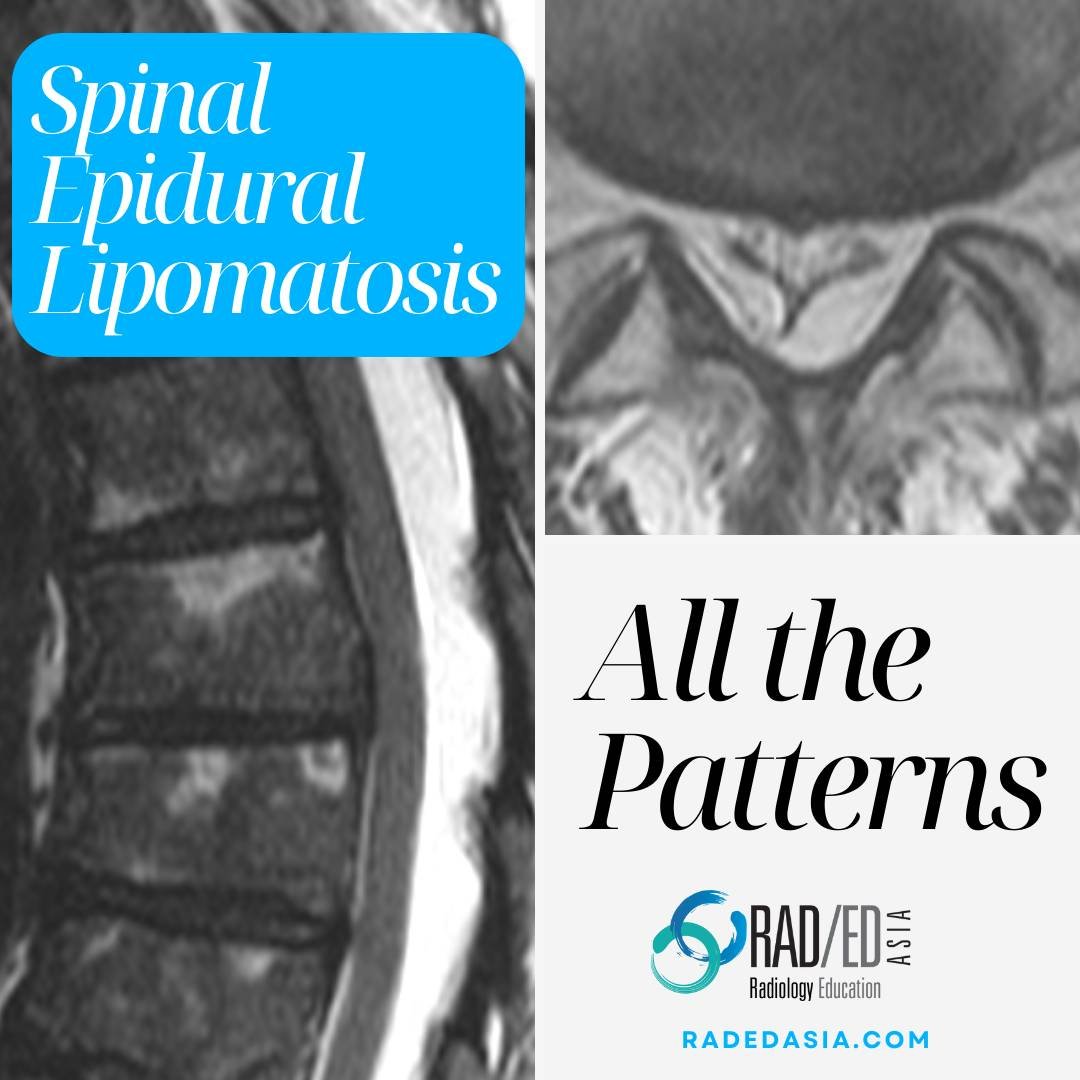 spinal epidural lipomatosis mri lumbar thoracic radedasia