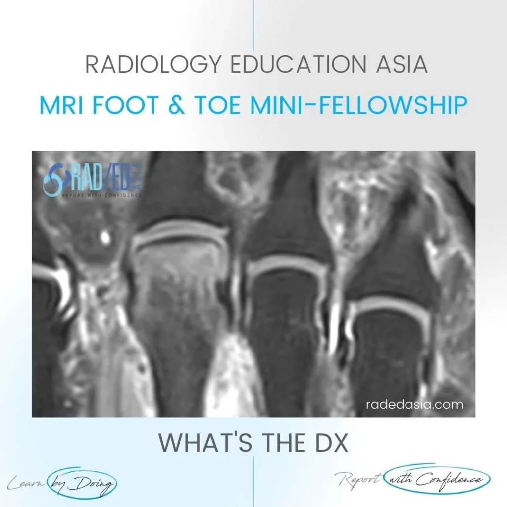 freiberg disease mri radiology toe radedasia