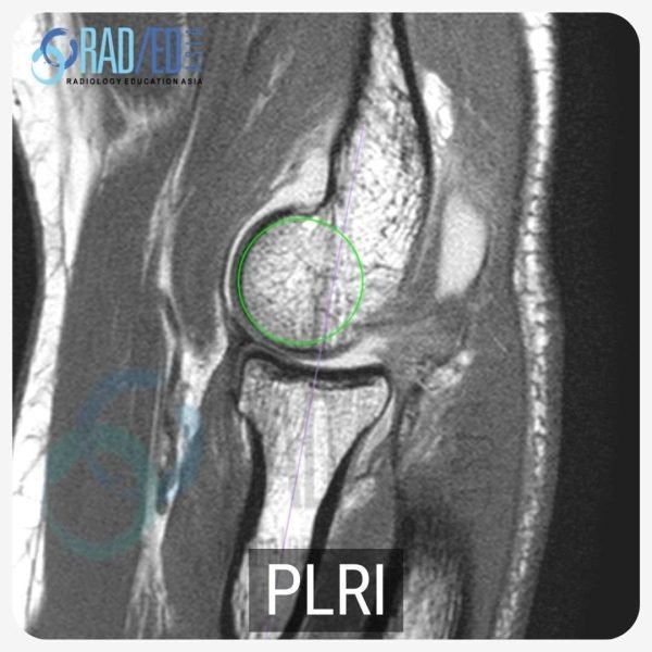 elbow lcl plri anterior subluxation capitellum radiology