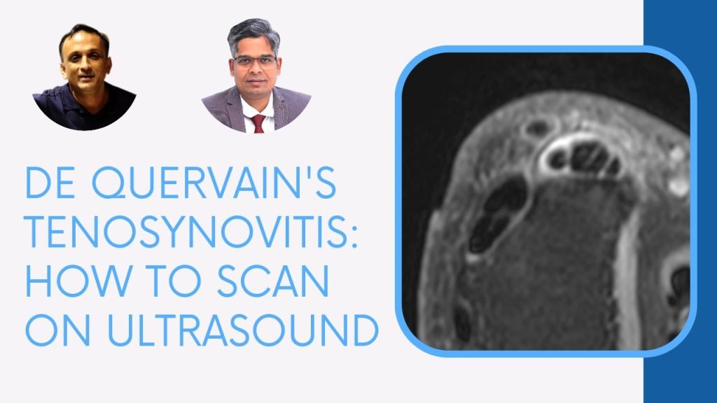 de quervain's tenosynovitis wrist ultrasound how to scan radiology radedasia
