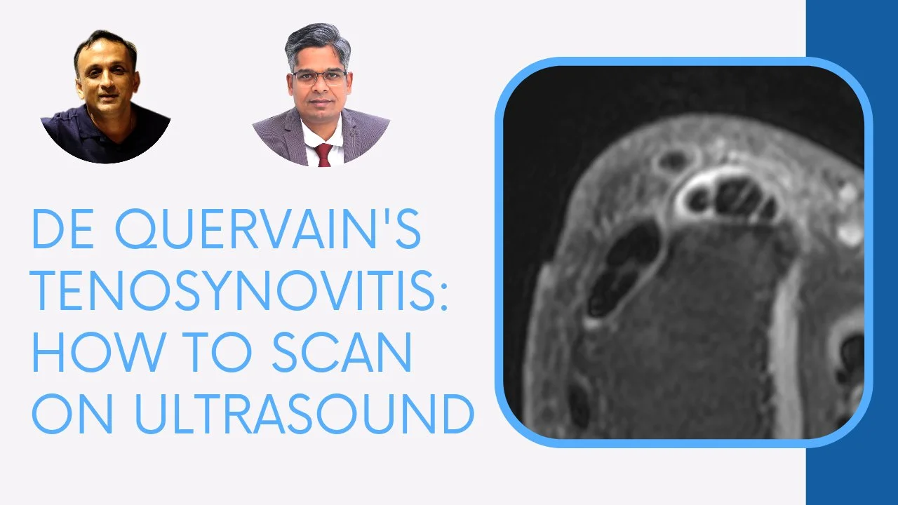 DE QUERVAIN'S TENOSYNOVITIS: HOW TO SCAN ON ULTRASOUND