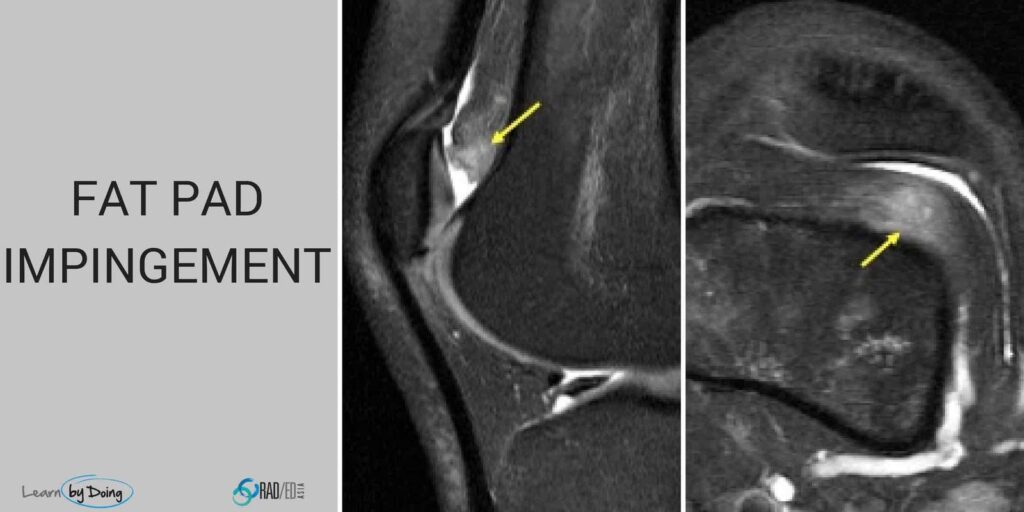 mri knee fat pad impingement radiology education asia