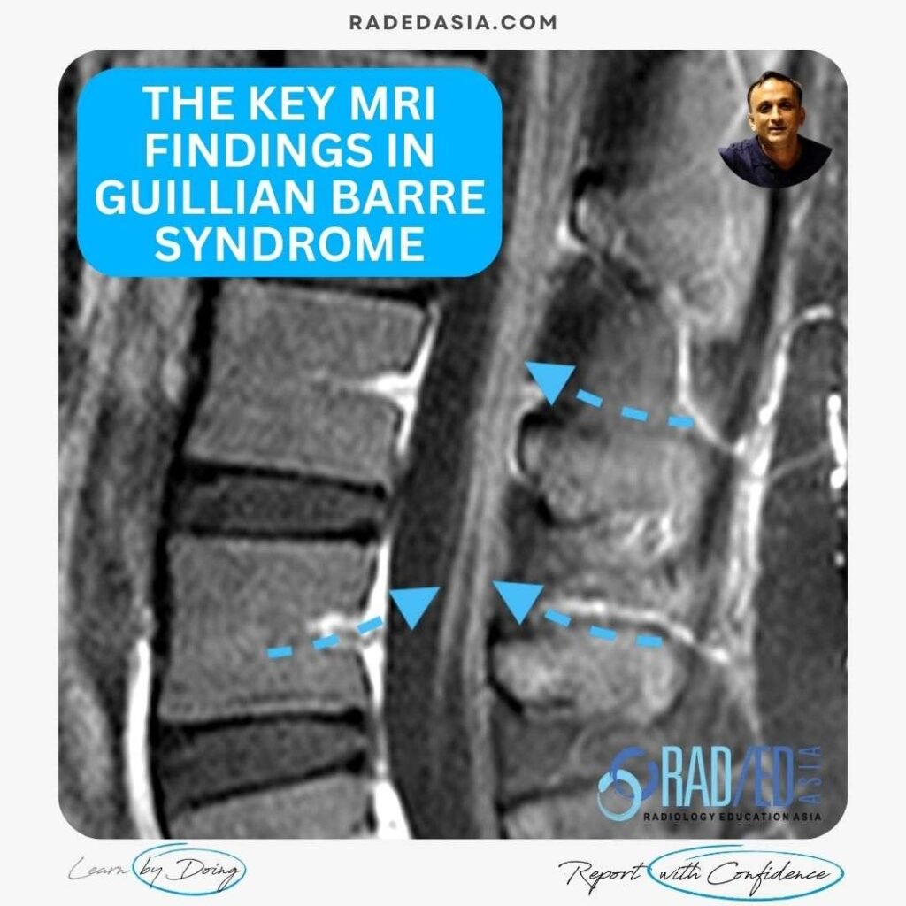 guillain-barre-syndrome-mri-findings-nerve-enhancement-spine-radiology-radedasia