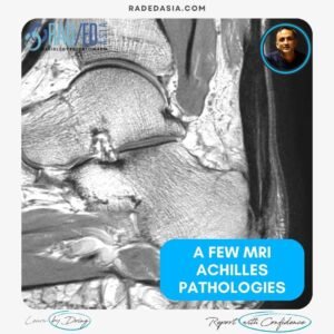 mri achilles tendon abnormalities ankle radiology