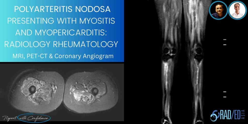 polyarteritis nodosa myopericarditis myositis mri pet ct coronary angiogram imaging radedasia