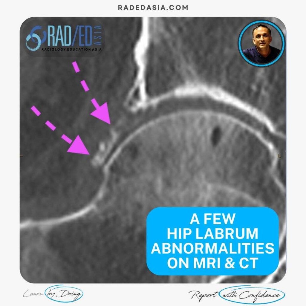 hip labrum tear paralabral cyst mucoid degeneration ossification mri ct radedasia