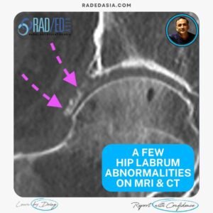 hip labrum tear paralabral cyst mucoid degeneration ossification mri ct radedasia