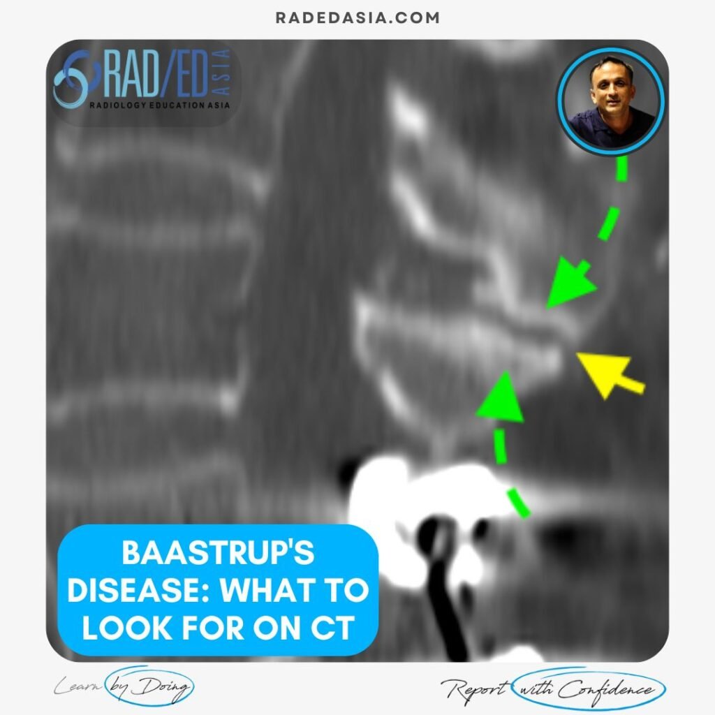 baastrup-disease-ct-findings-radedasia